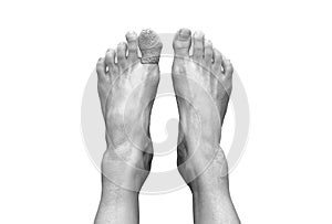 Top view picture of two bare human female feet with a wounded big toe healed with bandage for medical care. Black and white tone