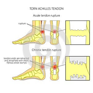 Torn Achilles tendon photo