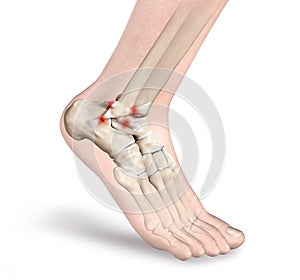 Torn ligament in ankle, 3D illustration