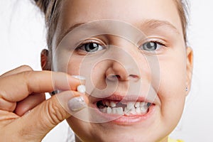 Torn out milk tooth between two fingers in front of little girl face behind with opened mouth showing teeth on white