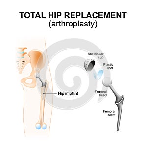 Total hip replacement or arthroplasty.