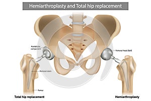 Total hip replacement components and Hemiarthroplasty. Implant