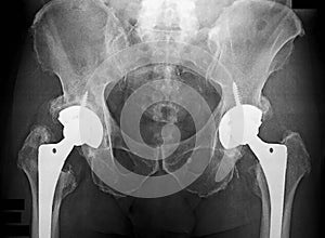 Total Hip replacement Xray, left and right