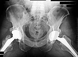 Total Hip replacement Xray, left and right