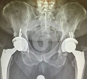 Total hips prosthesis xray image