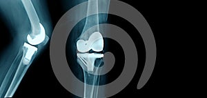 Total knee arthroplasthy