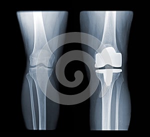 Total knee replacement