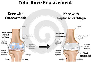 Total Knee Replacement