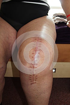 Total knee replacement, knee surgery.