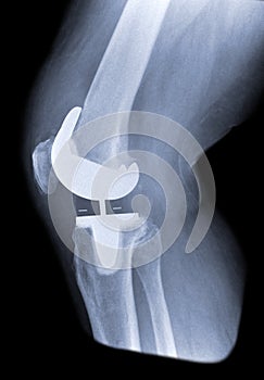 Total knee replacement side