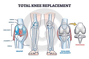 Total knee replacement surgery and prosthesis operation outline diagram