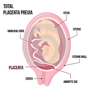 Total Placental previa. Dangerous Placenta Location During Pregnancy. Medical Pathology. detailed medical diagram with photo