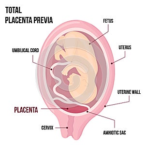 Total Placental previa. Dangerous Placenta Location During Pregnancy. Medical Pathology. detailed medical diagram with photo