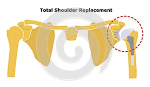 Total Shoulder Replacement. Shoulder joint replacement, endoprosthetics. Osteoarthrosis of the shoulder joint. Vector illustration