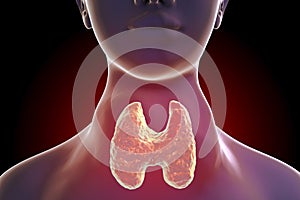 Toxic diffuse goiter, hyperthyroidism