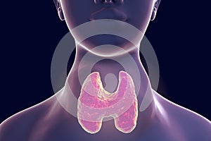 Toxic diffuse goiter, hyperthyroidism