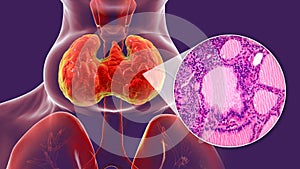 Toxic goiter, 3D illustration and micrograph