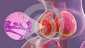 Toxic goiter, 3D illustration and micrograph