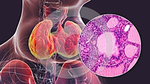 Toxic goiter, 3D illustration and micrograph