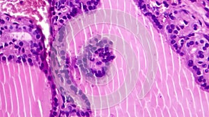 Toxic goiter histopathology, light micrograph footage