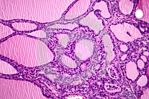 Toxic goiter, light micrograph