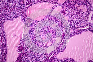 Toxic goiter, light micrograph
