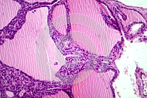 Toxic goiter, light micrograph