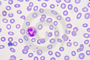 Toxic granulation refers to changes in granulocyte cells seen on