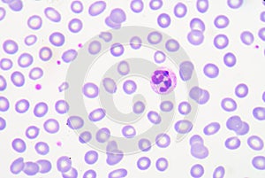 Toxic granulation refers to changes in granulocyte cells seen on photo