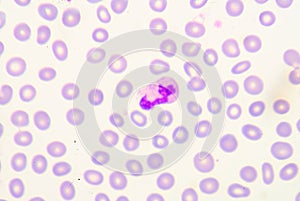 Toxic granulation refers to changes in granulocyte cells seen on photo