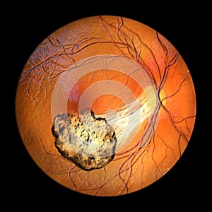 Toxoplasma retinochoroiditis observed during ophthalmoscopy, 3D illustration