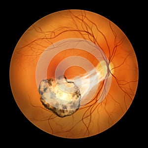 Toxoplasma retinochoroiditis observed during ophthalmoscopy, an illustration