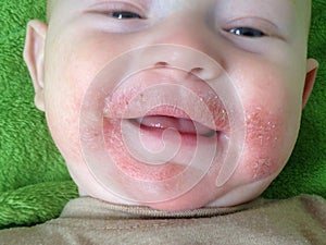 Traces of food allergies and atopic dermatitis on the face of the child