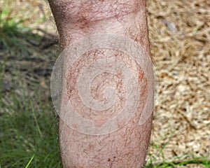 Traces of mosquito bites on the human leg