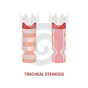 Trachea narrowing awareness icon of tracheal stenosis
