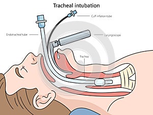 Tracheal intubation diagram medical science