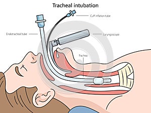 Tracheal intubation diagram medical science