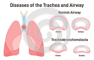 Tracheobronchomalacia. Airway and bronchial tubes disease. Soft and weak trachea