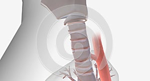 A tracheoesophageal fistula is an abnormal connection between the trachea (windpipe) and the esophagus