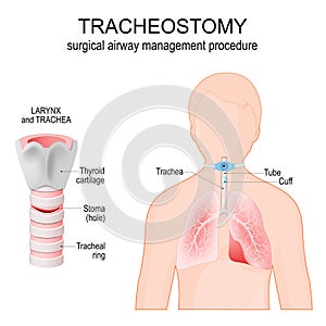 Tracheostomy. Anatomy of the trachea with stoma. larynx