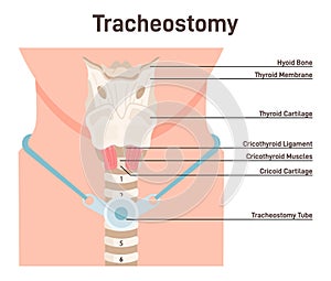 Tracheostomy. Tracheal surgery neutralise airway obstruction. Plastic cannula