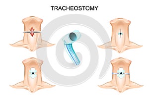 Tracheostomy. tracheostomy tube