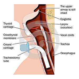 Tracheostomy tube placement photo