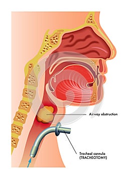 Tracheotomy