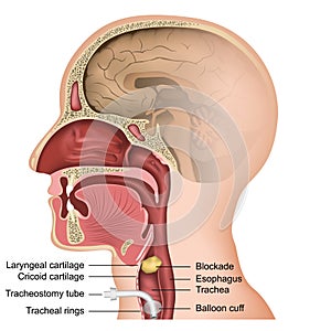 Tracheotomy medical vector illustration on white background
