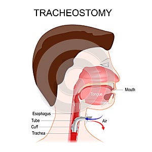 Tracheotomy. side view of the neck and the correct placement of a tracheostomy tube