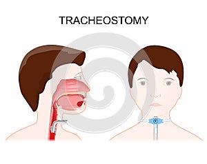 Tracheotomy. side view of the neck and placement of a tracheostomy tube