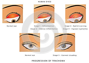 Trachoma of the eye