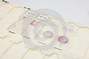 Traditional and liquid based cytology microscope slides for pap smear test. Cervical cancer concept. Medical concept