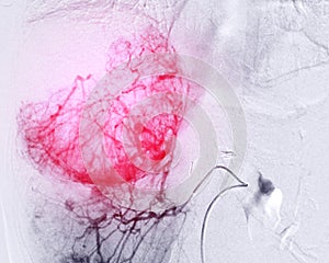 Transarterial Chemoembolization (TACE).